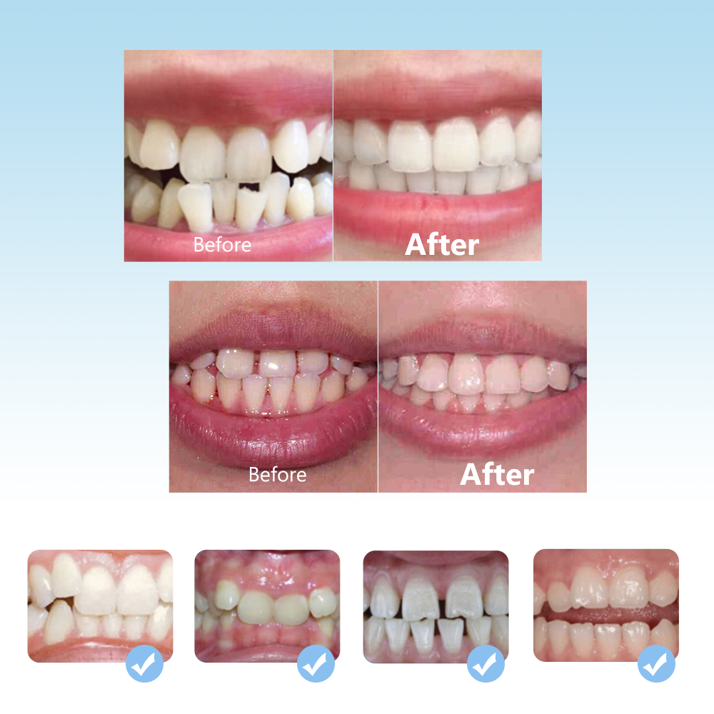 Dental ortodôntico chaves conj - Teeth Whitening With Braces avaliação e preço