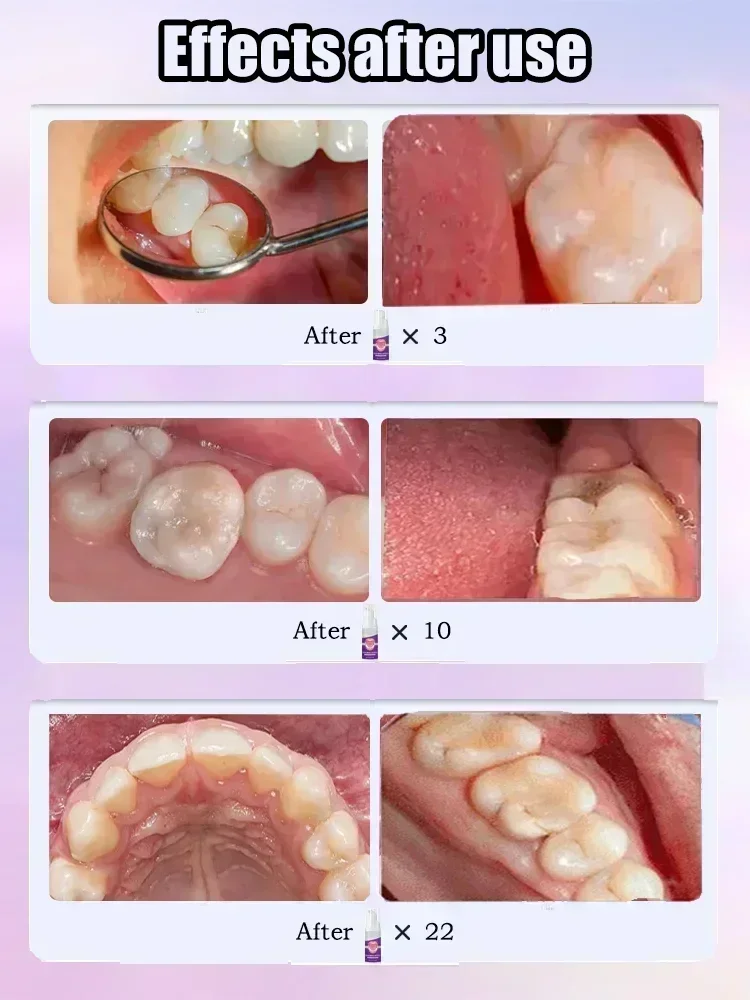 Reparação de Cáries, Proteção  - Teeth Whitening Foam avaliação e preço