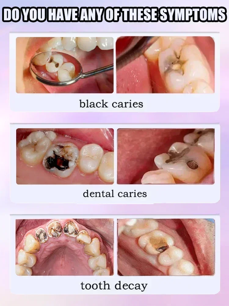 Reparação de Cáries, Proteção  - Teeth Whitening Foam avaliação e preço