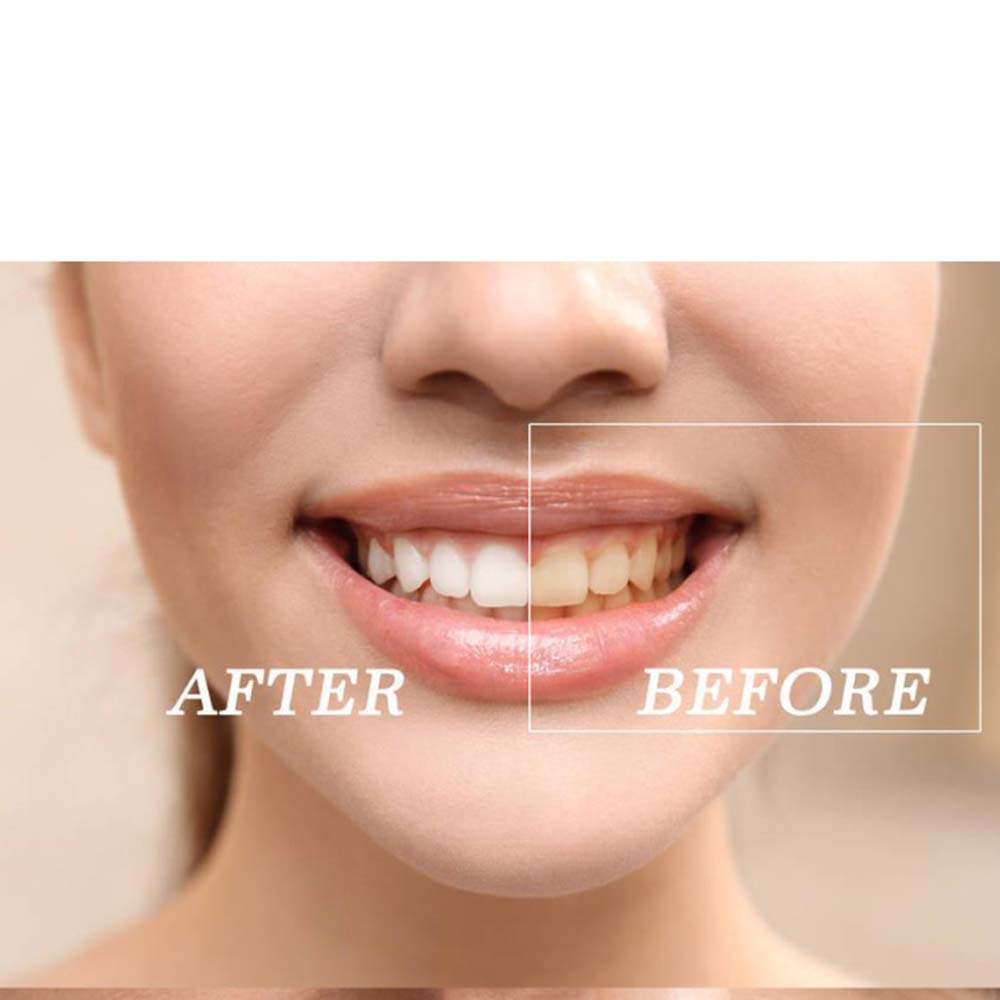 Kit de gel para clareamento de - Teeth Whitening Led Kit avaliação e preço
